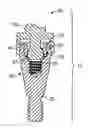 Fig. 01 - Fixed detachable dental attachment device, assembly and methods of using the same