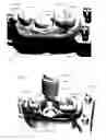 Fig. 04 - Support of removable components in a teeth model manufactured by means of CAM