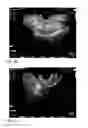 Fig. 11 - System and method for pelvic floor repair