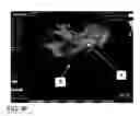 Fig. 13 - System and method for pelvic floor repair