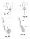 Fig. 02 - Embolus blood clot filter with bio-resorbable coated filter members