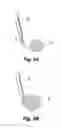 Fig. 04 - Embolus blood clot filter with bio-resorbable coated filter members