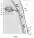 Fig. 08 - METHODS AND DEVICES FOR TREATING A HYPER-INFLATED LUNG