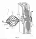 Fig. 26 - METHODS AND DEVICES FOR TREATING A HYPER-INFLATED LUNG