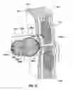 Fig. 35 - METHODS AND DEVICES FOR TREATING A HYPER-INFLATED LUNG