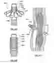 Fig. 46 - METHODS AND DEVICES FOR TREATING A HYPER-INFLATED LUNG