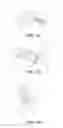 Fig. 04 - Accommodating intraocular lenses