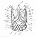 Fig. 01 - Endoprosthesis for implantation in the heart of a patient