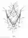Fig. 08 - Endoprosthesis for implantation in the heart of a patient