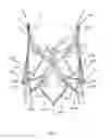 Fig. 09 - Endoprosthesis for implantation in the heart of a patient
