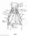 Fig. 22 - Endoprosthesis for implantation in the heart of a patient