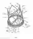 Fig. 29 - Endoprosthesis for implantation in the heart of a patient