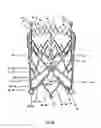 Fig. 31 - Endoprosthesis for implantation in the heart of a patient