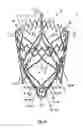 Fig. 32 - Endoprosthesis for implantation in the heart of a patient