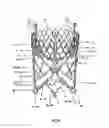 Fig. 34 - Endoprosthesis for implantation in the heart of a patient