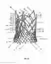 Fig. 42 - Endoprosthesis for implantation in the heart of a patient