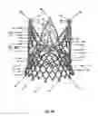 Fig. 45 - Endoprosthesis for implantation in the heart of a patient