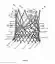 Fig. 46 - Endoprosthesis for implantation in the heart of a patient