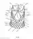 Fig. 49 - Endoprosthesis for implantation in the heart of a patient