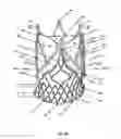 Fig. 50 - Endoprosthesis for implantation in the heart of a patient