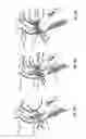 Fig. 56 - Endoprosthesis for implantation in the heart of a patient