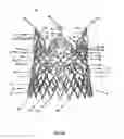 Fig. 59 - Endoprosthesis for implantation in the heart of a patient