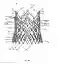 Fig. 60 - Endoprosthesis for implantation in the heart of a patient
