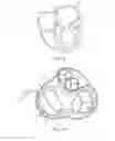 Fig. 08 - Devices and methods for treating valvular regurgitation