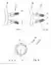Fig. 03 - SET FOR CONNECTING A PROSTHETIC ASSEMBLY OF AN ARTIFICIAL JOINT TO A BONE