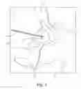 Fig. 07 - JOINT IMPLANT, METHOD OF MAKING AND SURGICAL PROCEDURE FOR IMPLANTING THE SAME