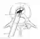 Fig. 01 - Implantable spinal insert system