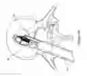 Fig. 11 - Implantable spinal insert system