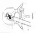 Fig. 12 - Implantable spinal insert system