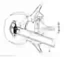 Fig. 13 - Implantable spinal insert system