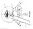 Fig. 14 - Implantable spinal insert system