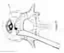 Fig. 15 - Implantable spinal insert system