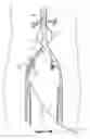 Fig. 09 - Endograft delivery device assembly