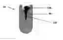 Fig. 01 - Gastric device and method of use thereof