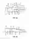 Fig. 05 - Disposable tape kit and method for wrist immobilization