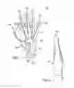 Fig. 02 - Rehabilitative Glove Device