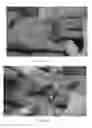Fig. 04 - Proteolytic extract from bromelain for the treatment of connective tissue disorders
