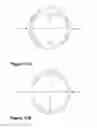 Fig. 07 - Tracheostomy guard