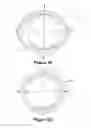 Fig. 11 - Tracheostomy guard
