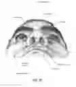 Fig. 10 - Patient interface