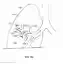 Fig. 03 - Devices for delivering substances through an extra-anatomic opening created in an airway