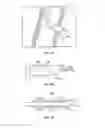 Fig. 10 - Devices for delivering substances through an extra-anatomic opening created in an airway