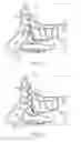 Fig. 09 - Balloon dilation catheter for use in sinus passageways