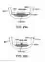 Fig. 44 - Swallowable drug delivery device and methods of drug delivery
