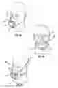 Fig. 06 - FILTERING FACE RESPIRATOR HAVING OPTIMIZED FACIAL FILTER LOCATION