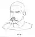 Fig. 06 - Mouthheld filter apparatus